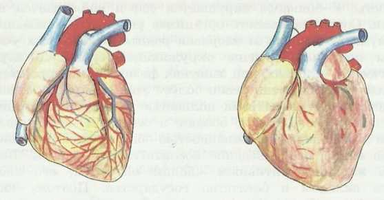 Сердце здорового человека (слева) и сердце алкоголика (справа)